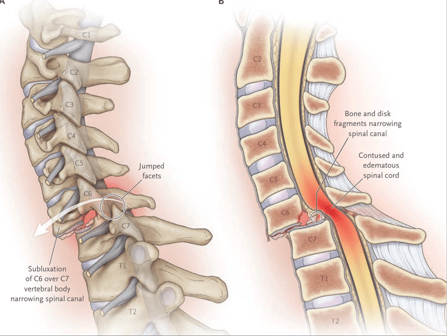 acute spinal cord injury